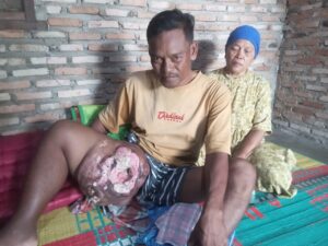 Rudi Nainggolan Penderita Tumor Seberat 3 Kg, Minta Uluran Tangan Bupati Asahan Untuk Penanganan Medis